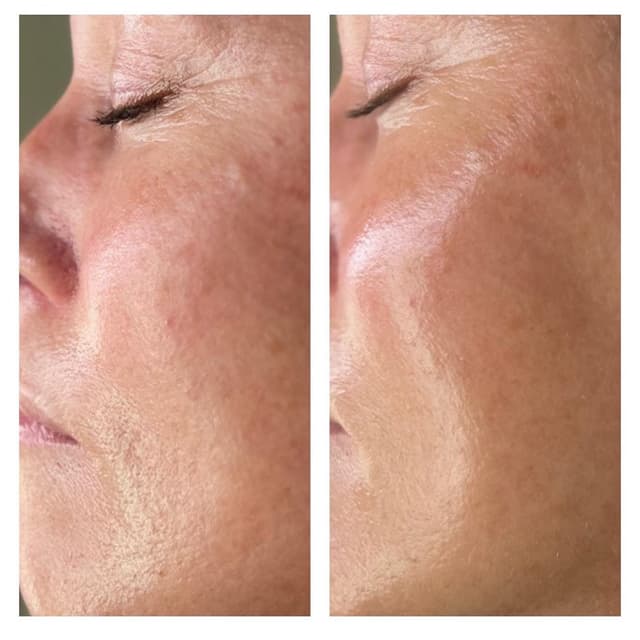 Lift & Tighten Collagen Facial at Trubeauty Esthetics in Ammon, ID