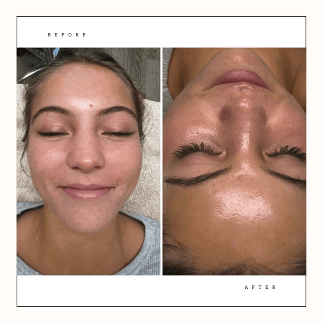 Get Glowing Micro Peel